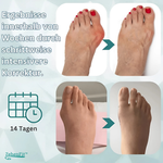 Charger l'image dans la galerie, ZehenFit™ Hallux Valgus Korrektur &amp; Zehenspreizer
