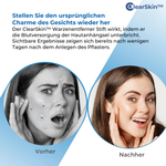 Charger l'image dans la galerie, ClearSkin™ Warzenentferner Stift
