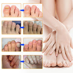 Charger l'image dans la galerie, 1+1 Gratis | Nalix™ - Wirksame Behandlung von Nagelpilz
